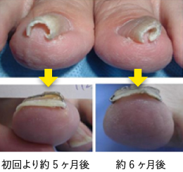 巻き爪の矯正前と矯正後